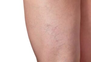 Effective Spider Veins Treatment In Dubai for Smooth and Clear Skin Appearance