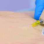 Stretch Mark Removal Treatment in Mumbai by Adore Radiant, and Confident Skin