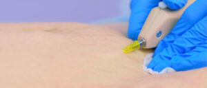 Stretch Mark Removal Treatment in Mumbai by Adore Radiant, and Confident Skin 1 Stretch Mark Removal Treatment in Mumbai by Adore Radiant, and Confident Skin