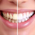 Types of Teeth Whitening What You Should Know