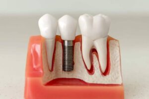 Why Dental Implants Look and Feel Like Natural Teeth 1 Why Dental Implants Look and Feel Like Natural Teeth