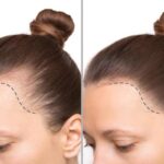 Hair transplantDubai
