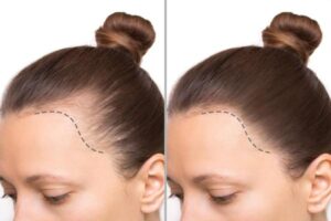 وداعاً للصلع: أفضل تقنيات زراعة الشعر في دبي