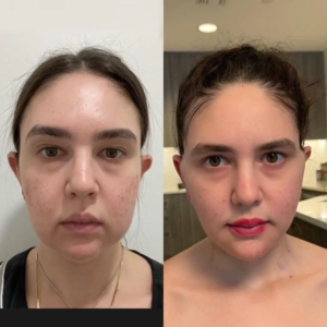 How Facial Structure Influences Buccal fat removal Surgery in dubai