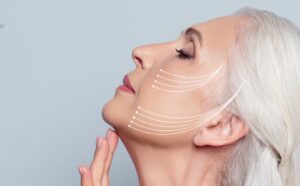 Achieving a V-Shaped Face With Thread Lift Treatment