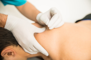 Looking for Dry Needling Near Me? Discover an Effective Solution for Muscle Pain and Recovery 1 Looking for Dry Needling Near Me? Discover an Effective Solution for Muscle Pain and Recovery
