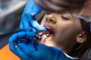Wisdom Tooth Removal in Toronto: 7 Warning Signs 1 Wisdom Tooth Removal in Toronto: 7 Warning Signs