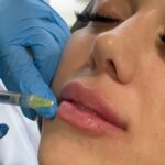restylane dubai4 1