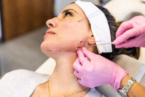 Thread Lift in London: Everything You Need to Know