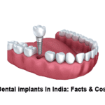 dental implant clinic in india