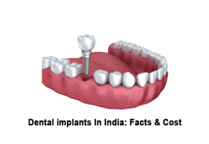 Cost to Get All-on-4 Dental Implants in India: Myths, Aftercare & Long-Term Maintenance