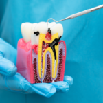 Toothache or Tooth Sensitivity? When Do You Need a Root Canal?