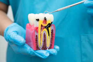 Toothache or Tooth Sensitivity? When Do You Need a Root Canal?
