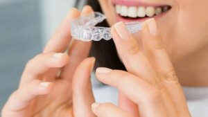 What Should You Know About Invisalign Overbite Treatment?