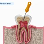 AD Blogs How Long Does a Root Canal Last Image 1