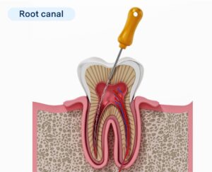 Root Canal Retreatment: Busting Myths, Aftercare Tips & Long-Term Maintenance