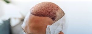 Restore Confidence with Advanced Hair Transplants in Dubai