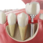 Don’t Delay Dental Implants: Why Bhandara Patients Should See a Specialist Early