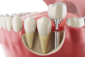 Don’t Delay Dental Implants: Why Bhandara Patients Should See a Specialist Early