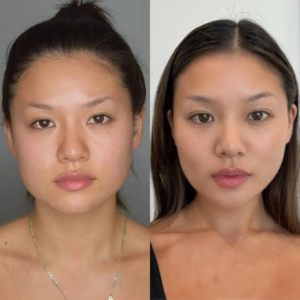 Trending Beauty Goals Achieved Through Buccal fat removal Surgery in dubai