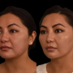 Chin liposuction 1