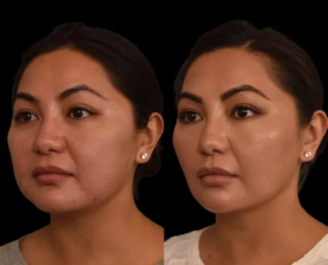 Why Double chin removal Surgery in dubai Is Popular Among Women