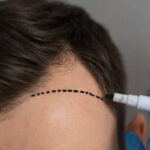 How much does 5000 grafts Hair Transplant Cost in Riyadh 9