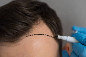 Tips for Maintaining Results After a 5000 Grafts Hair Restoration
