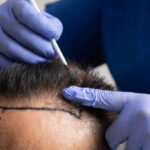 How Lifestyle and Diet Influence Hair Transplant Outcomes in Riyadh