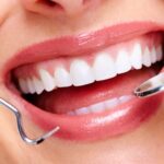 Lumineers Teeth Houston Guide for a Natural Looking Smile Makeover 3 Lumineers Teeth Houston Guide for a Natural Looking Smile Makeover