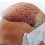 Hair Restoration in Dubai for Men and Women Explained