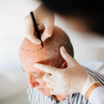 Exploring Hair Transplant in Riyadh for Stronger Hair Restoration Results 3 Exploring Hair Transplant in Riyadh for Stronger Hair Restoration Results