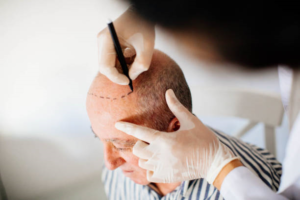 Exploring Hair Transplant in Riyadh for Stronger Hair Restoration Results 1 Exploring Hair Transplant in Riyadh for Stronger Hair Restoration Results