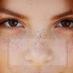 Freckles and Blemishes in Dubai3