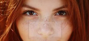 Why Enfield Royal Clinic Is Trusted for Freckles and Blemishes Treatment