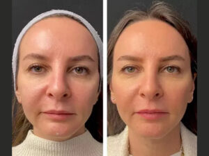 Best Plastic Surgeons in Dubai Discuss Mesotherapy for Face, Neck, and Hands