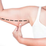 Arm Lift Surgery in Dubai 9