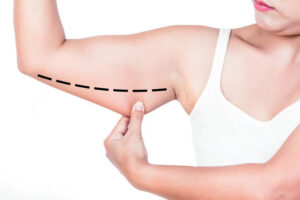Where to Get Arm Lift Surgery in Dubai with Confidence