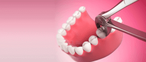 Teeth Removal Cost in India: Types, Procedures, and What to Expect from Surgery
