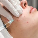 Acne Treatment in Manchester: Clear Skin Solutions for a Healthier, Confident You 3 Acne Treatment in Manchester: Clear Skin Solutions for a Healthier, Confident You