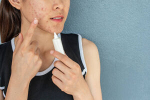Acne Treatment in Noida, India & Skin Doctor Near Me is offered by Dr. Roshni Saraf dermatological treatments 1 Acne Treatment in Noida, India & Skin Doctor Near Me is offered by Dr. Roshni Saraf dermatological treatments
