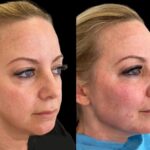 Cheek Fillers Injection Guide at Best Aesthetic Clinics in Dubai