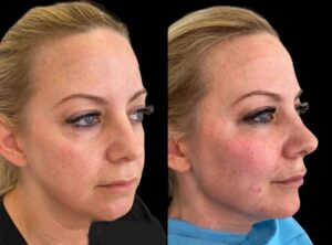 Cheek Fillers Injection Guide at Best Aesthetic Clinics in Dubai 1 Cheek Fillers Injection Guide at Best Aesthetic Clinics in Dubai