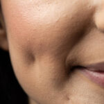 Dimple Creation in Dubai with Quick Recovery