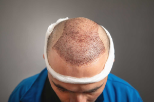 Advanced Robotic Hair Transplant in Abu Dhabi 1 Advanced Robotic Hair Transplant in Abu Dhabi