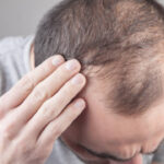 Hair Loss Treatment That Supports Natural Hair Growth Without Surgery