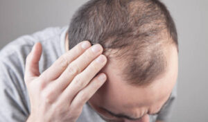 Hair Loss Treatment That Supports Natural Hair Growth Without Surgery