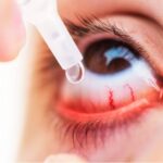 Breathe Easier with Expert Care for Persistent Eye Allergies