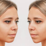 Septoplasty and Turbinate Reduction in Dubai Options 3 Septoplasty and Turbinate Reduction in Dubai Options