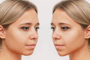 Septoplasty and Turbinate Reduction in Dubai Options 1 Septoplasty and Turbinate Reduction in Dubai Options